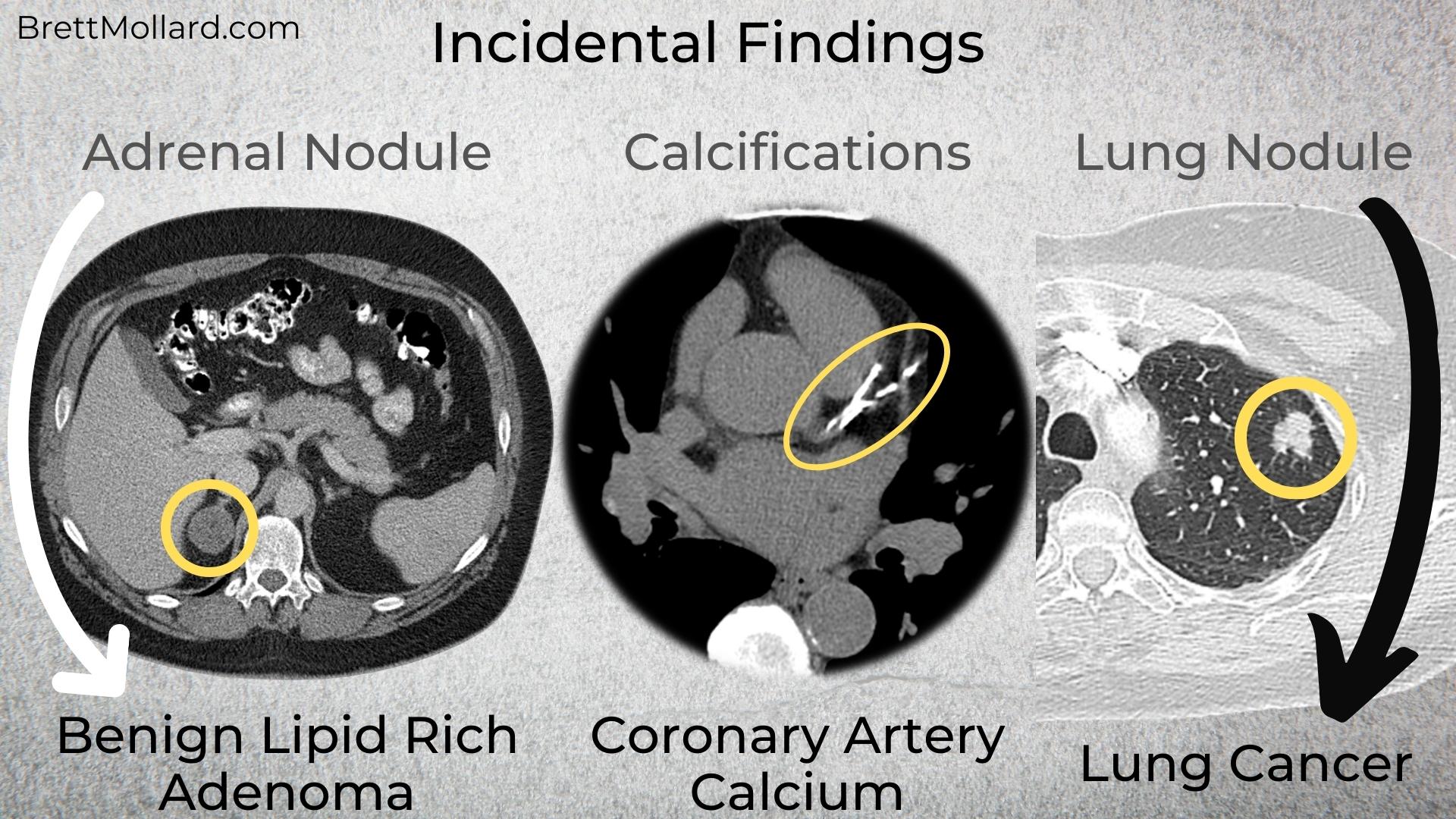 Incidental Findings Examples - BrettMollard.com
