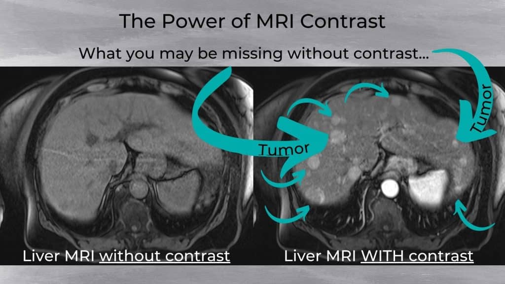 Can I Refuse Contrast Dye for MRI Scans - why you shouldn't