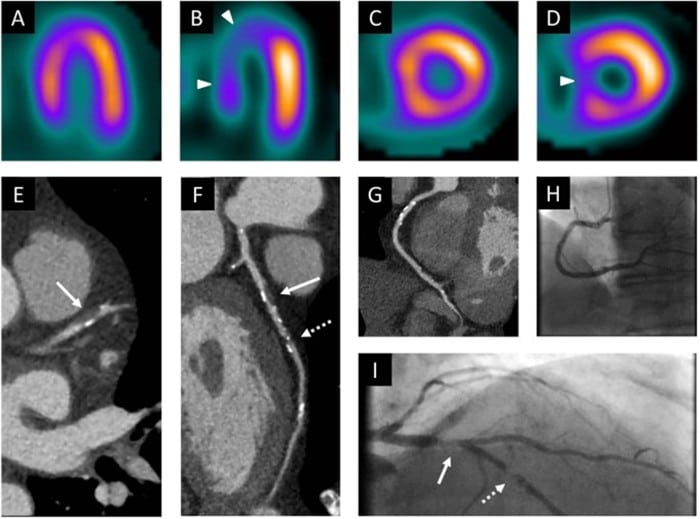 Nuclear Stress Test - Example