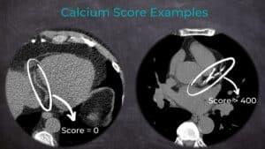 Why No Caffeine Before Calcium Scoring Calcium Score Examples